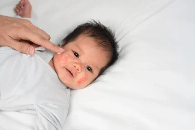 Penyebab Eksim pada Bayi dan Cara Mengatasinya - Nutriclub