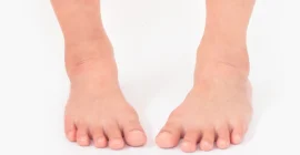 Bentuk kaki O - Nutriclub