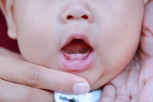pertumbuhan gigi bayi yang tidak normal - Nutriclub