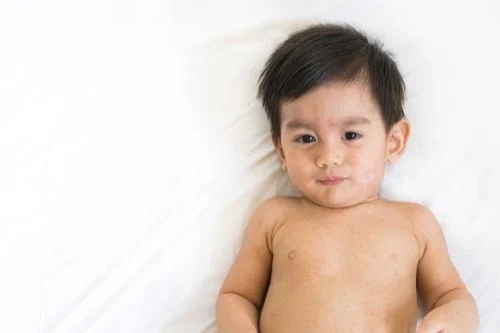 Bayi kena campak sebelum imunisasi campak - Nutriclub