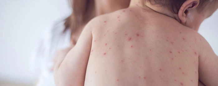 Banner Artikel 7 Penyebab Bintik Merah pada Kulit Bayi dan Cara Mengatasinya