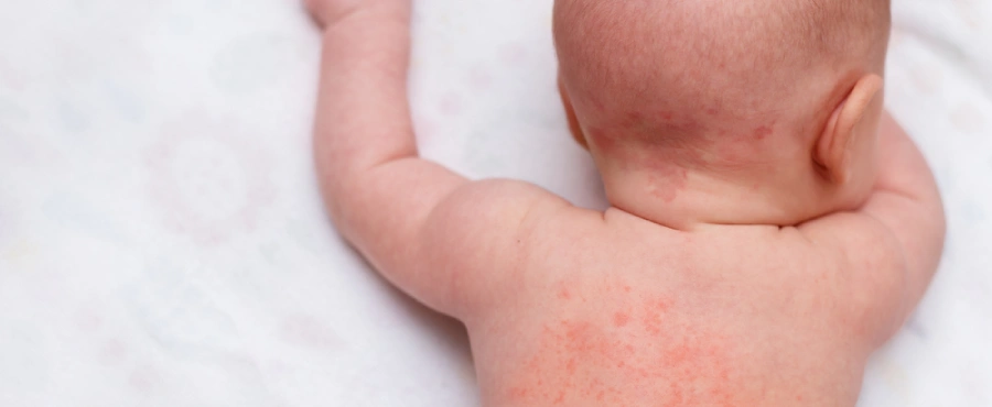 biang keringat pada bayi-nutriclub