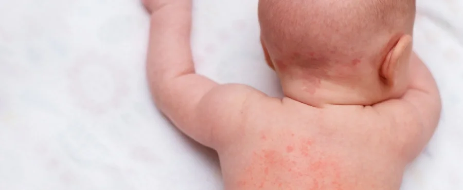 biang keringat pada bayi-nutriclub