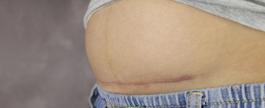 pasca operasi caesar-nutriclub