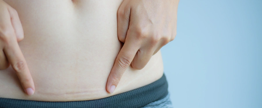 cara merawat luka caesar setelah buka perban-Nutriclub