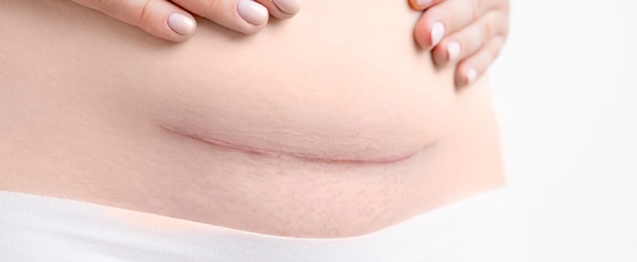 Banner Artikel Tanda Luka Dalam Operasi Caesar Sembuh & Kapan Perlu Waspada