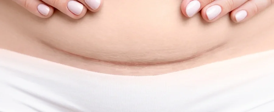 Berapa lama luka caesar sembuh​-Nutriclub