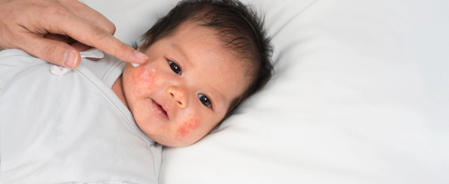 Banner Artikel Penyebab Alergi pada Bayi, Gejala, Cara Mengatasi, dan Apakah Bisa Sembuh? Banner Artikel Penyebab Alergi pada Bayi, Gejala, Cara Mengatasi, dan Apakah Bisa Sembuh?