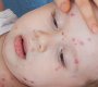 Kenali Faktor Penyebab Alergi pada Si Kecil