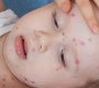 kenali-faktor-penyebab-alergi-pada-bayi_large